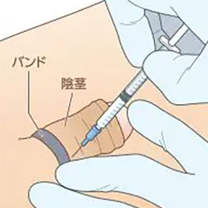 改善男性功能（勃起强度疗法）-1