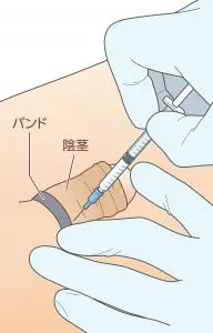 改善男性功能（勃起强度疗法）-2