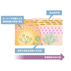 特应性皮炎干细胞疗法