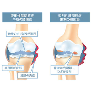 膝骨关节炎干细胞疗法-1